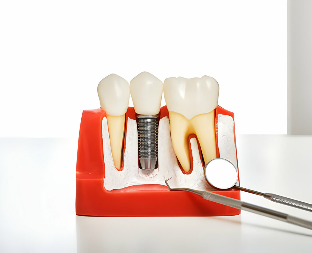 Living With Dental Implants: What To Expect After Surgery_1