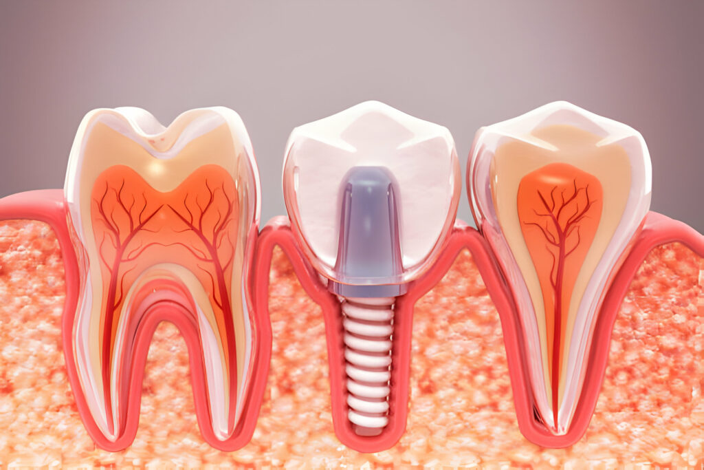 Living With Dental Implants: What To Expect After Surgery_3