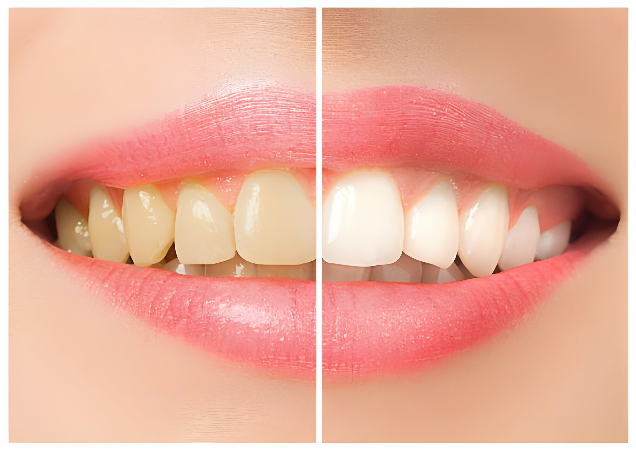 The Ultimate Guide to Teeth Whitening: Methods, Myths, and Must-Knows_FI