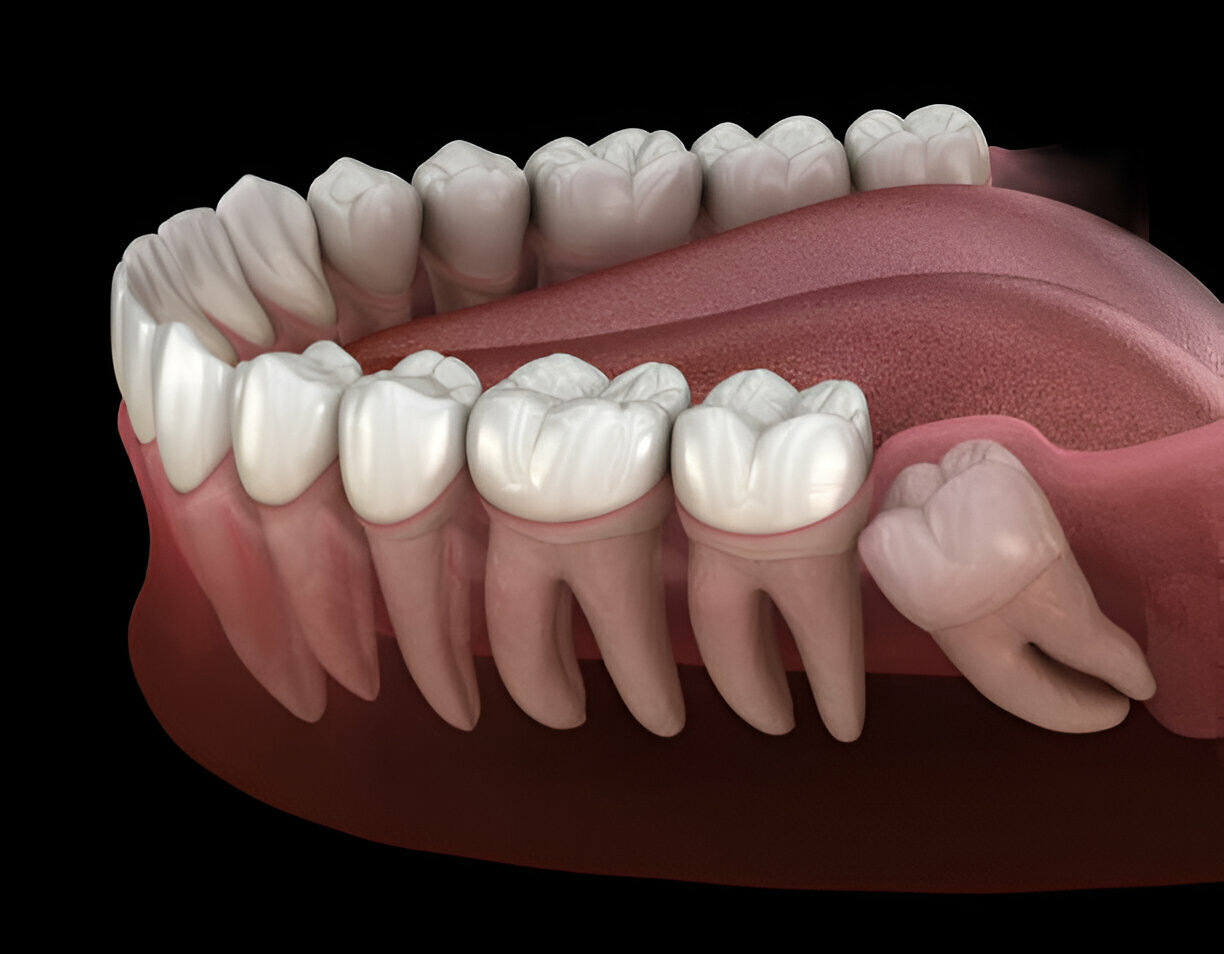 The Ultimate Guide to Wisdom Tooth Extraction_FI