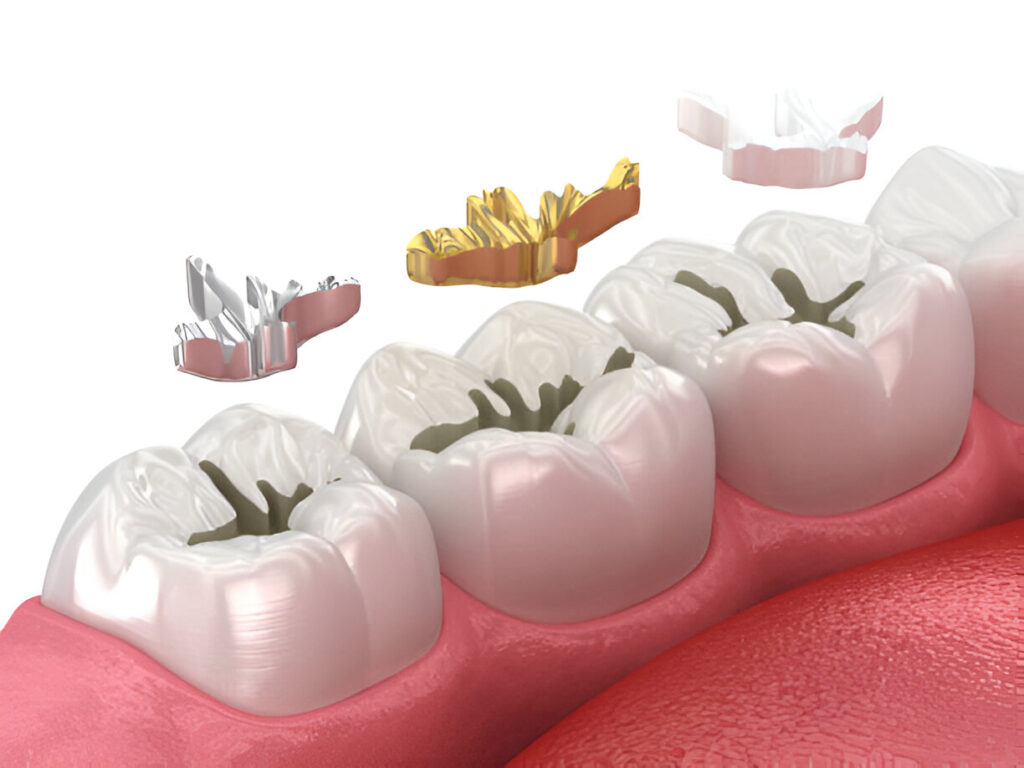 Why Choose Tooth-Colored Fillings? A Deep Dive into Their Types and Advantages_1