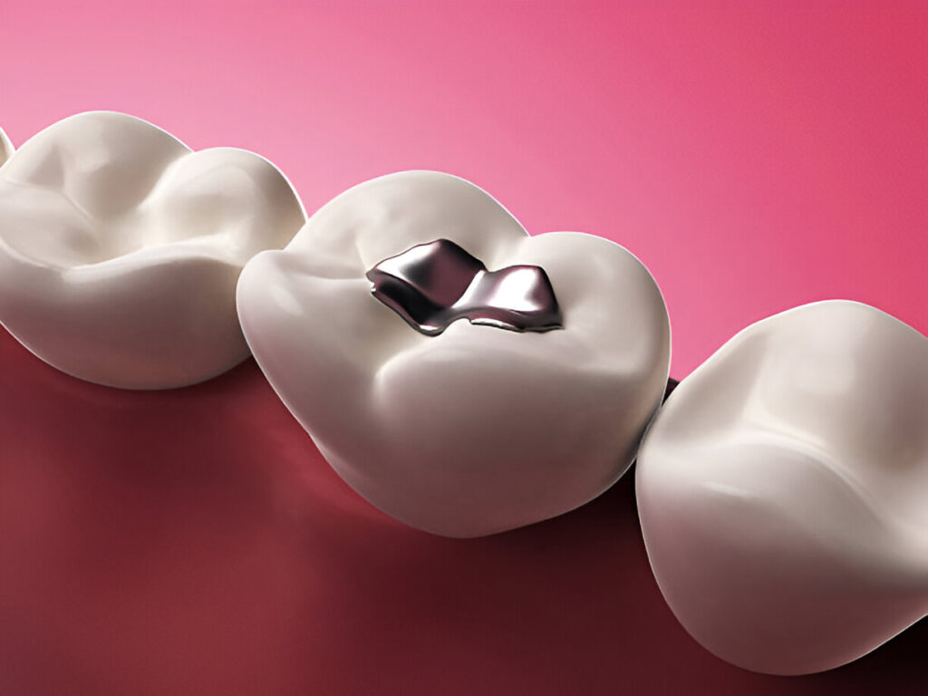 Why Choose Tooth-Colored Fillings? A Deep Dive into Their Types and Advantages_2